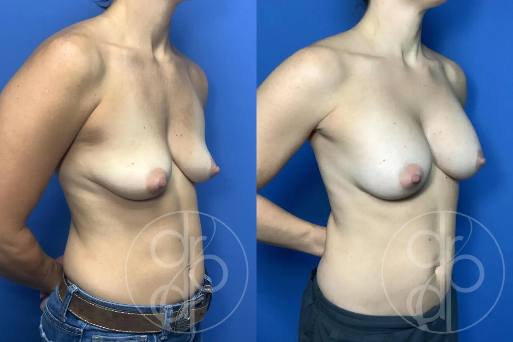 Breast Augmentation: Patient 93 - Before and After 2