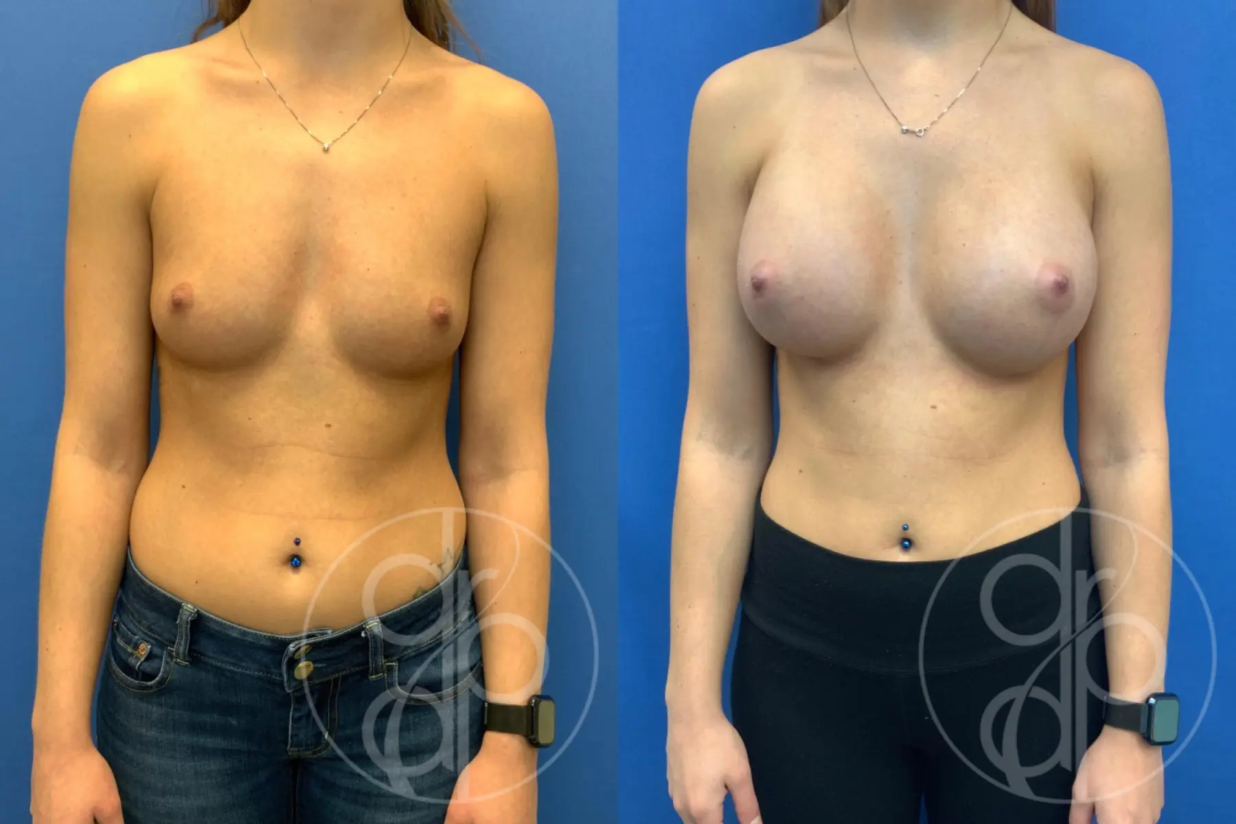 patient 10657 breast augmentation before and after result - Before and After 1
