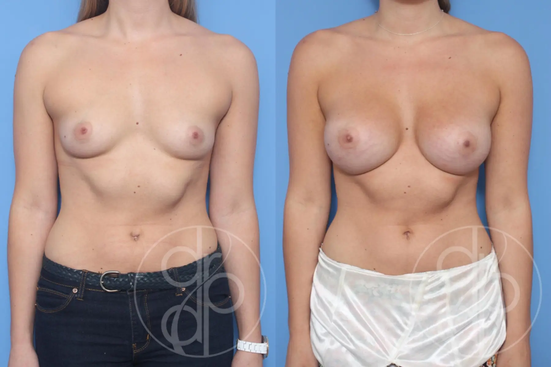 patient 14165 breast augmentation before and after result - Before and After 1