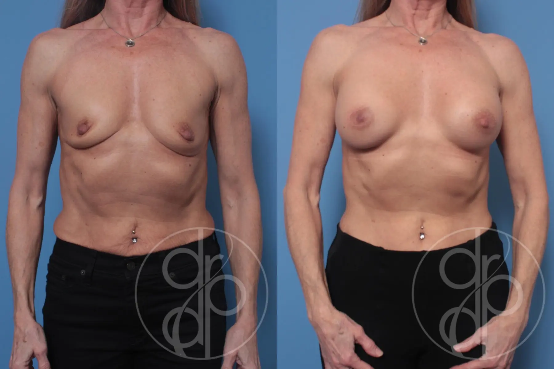 patient 10182 breast augmentation before and after result - Before and After 1
