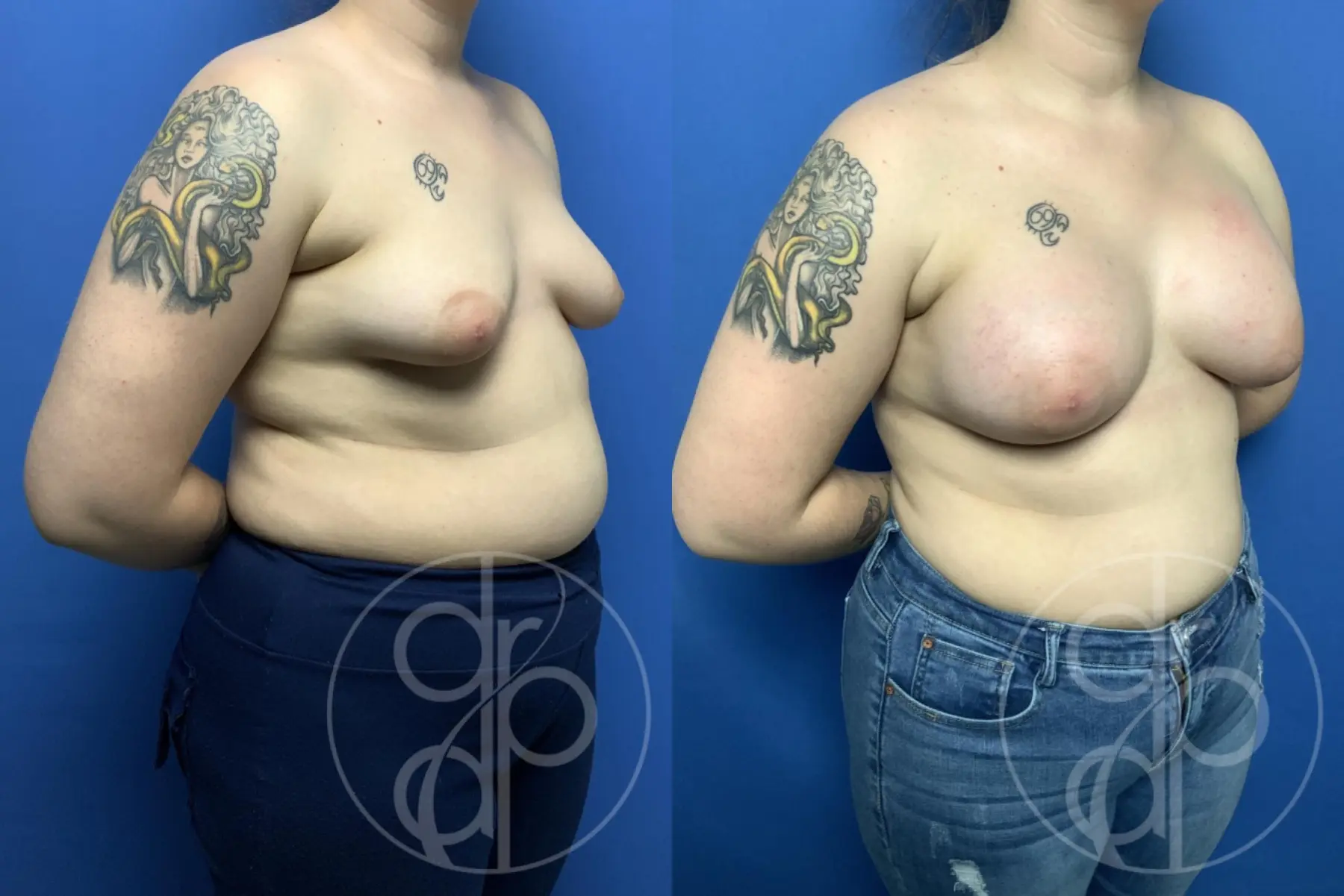 patient 13547 breast augmentation before and after result - Before and After 2