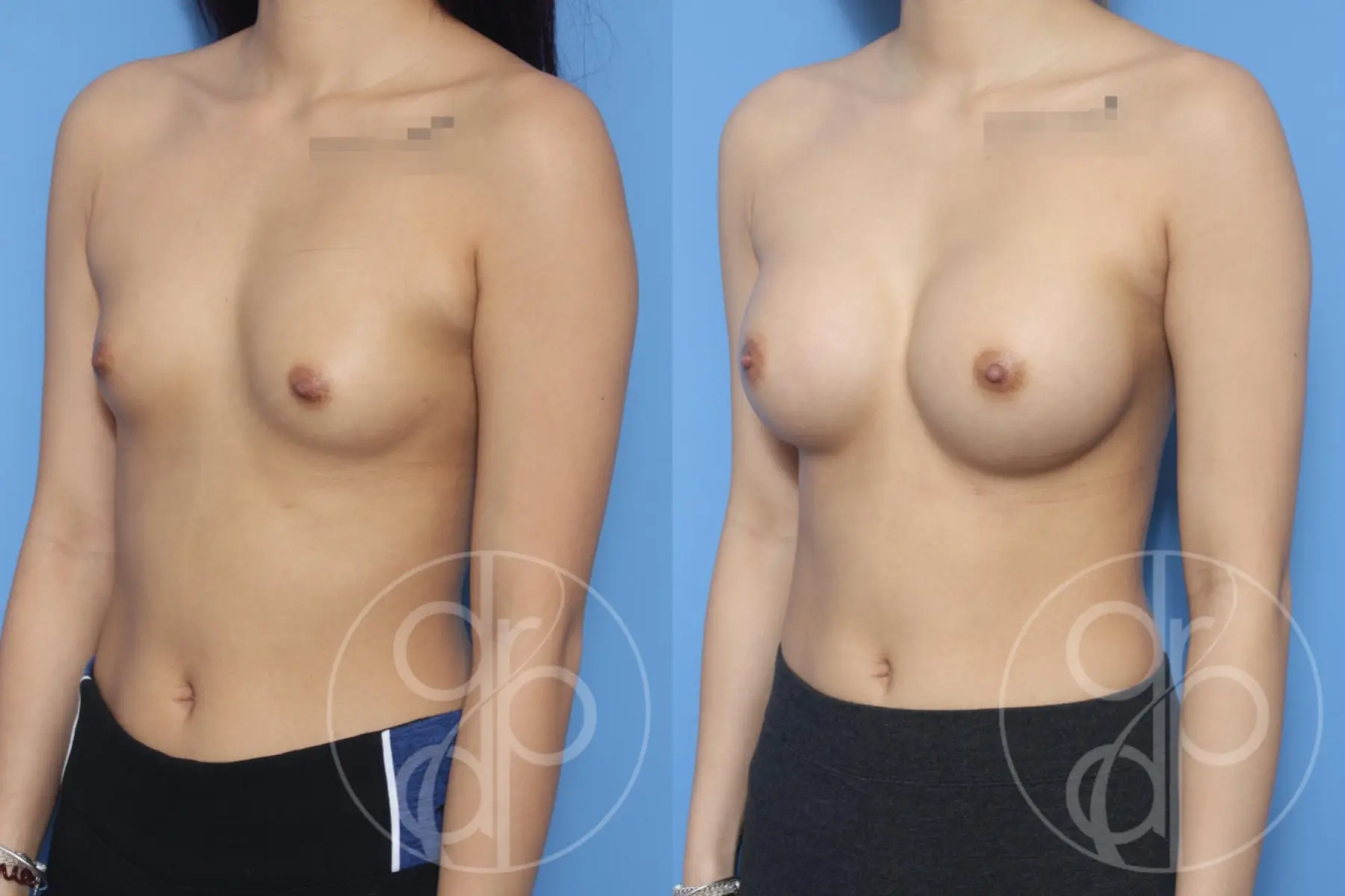 patient 11868 breast augmentation before and after result - Before and After 3