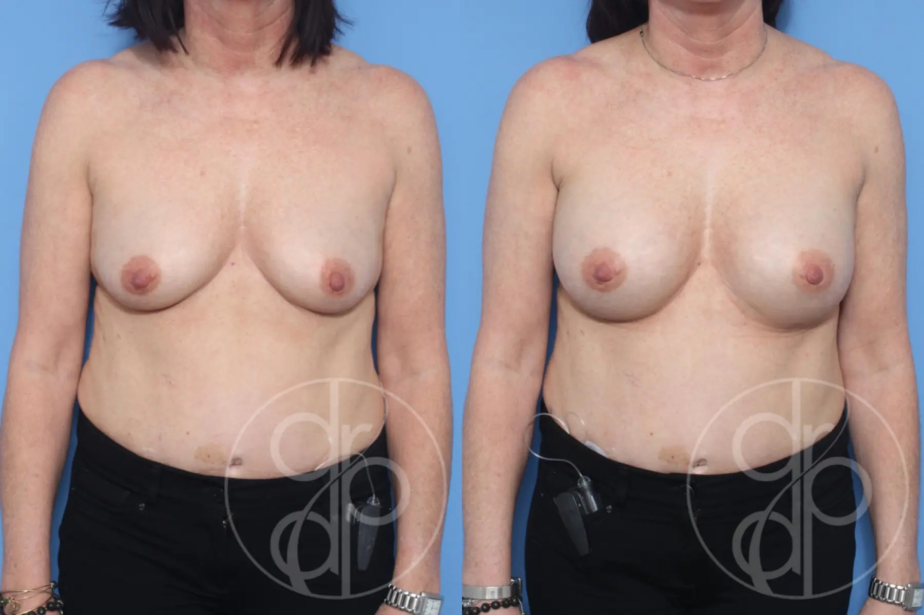 patient 13055 breast augmentation before and after result - Before and After 1