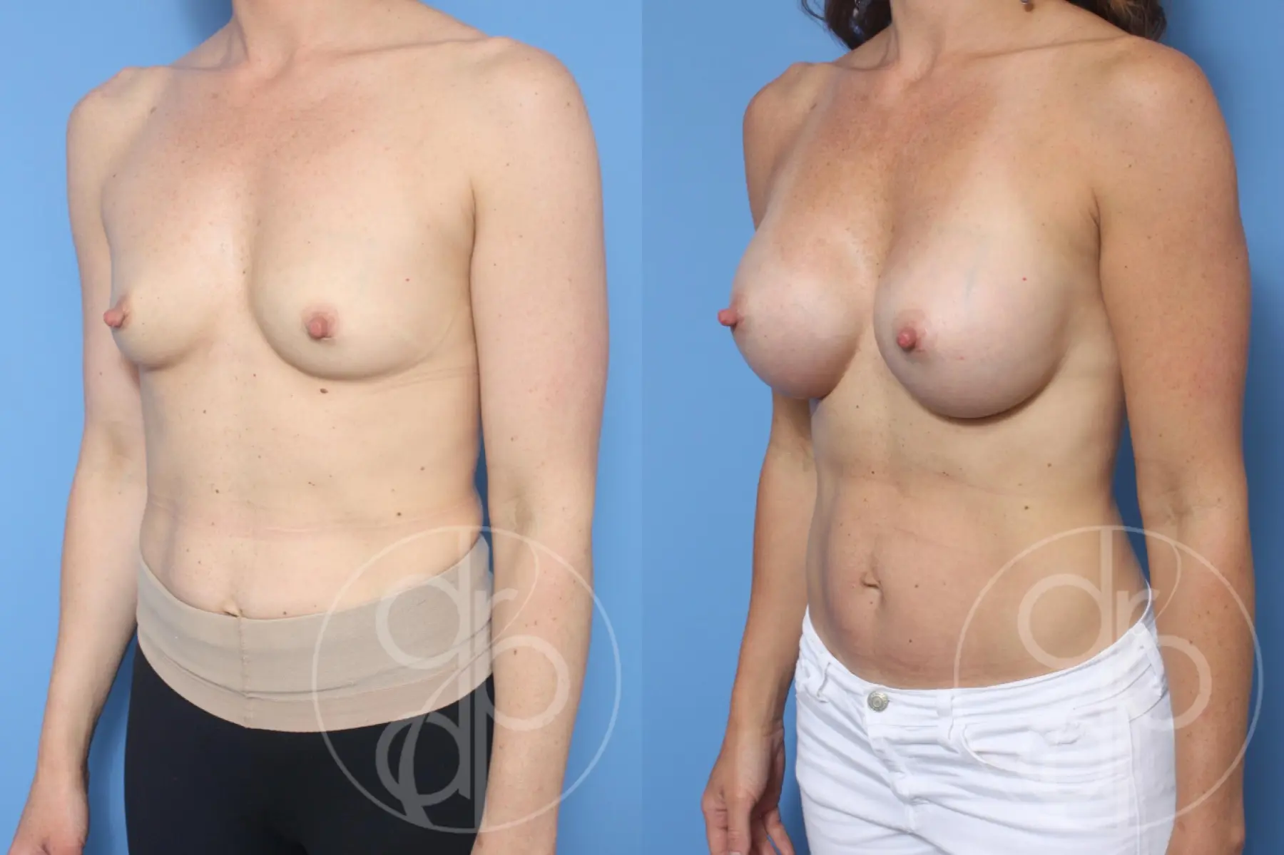patient 10587 breast augmentation before and after result - Before and After 3