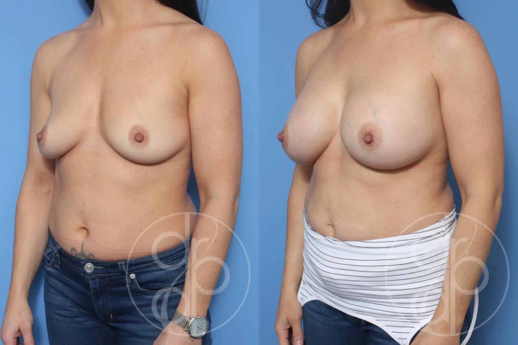 patient 10514 breast augmentation before and after result - Before and After 3