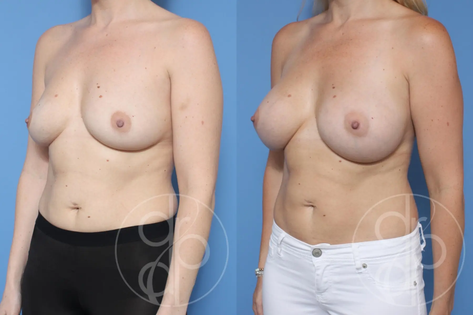 patient 10218 breast augmentation before and after result - Before and After 3