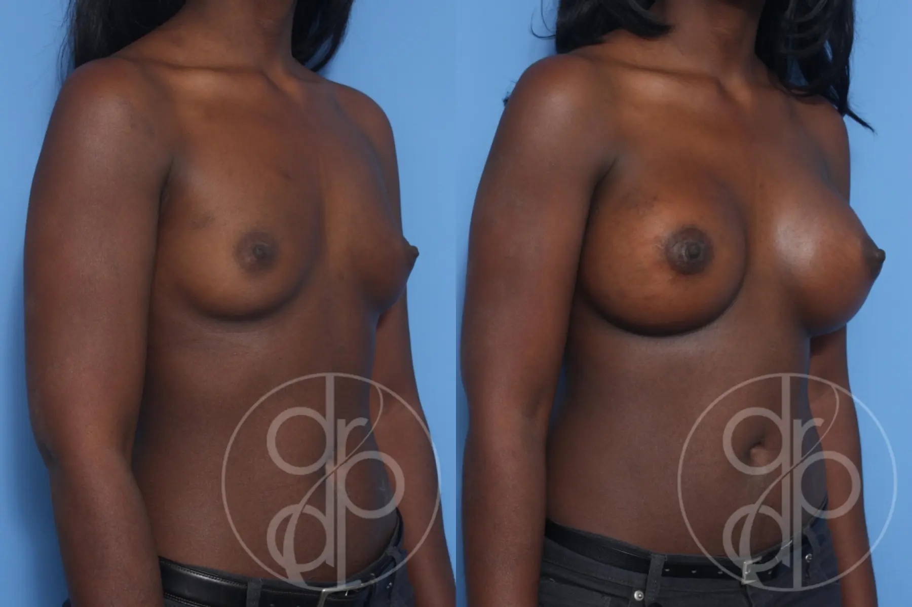 patient 12947 breast augmentation before and after result - Before and After 2