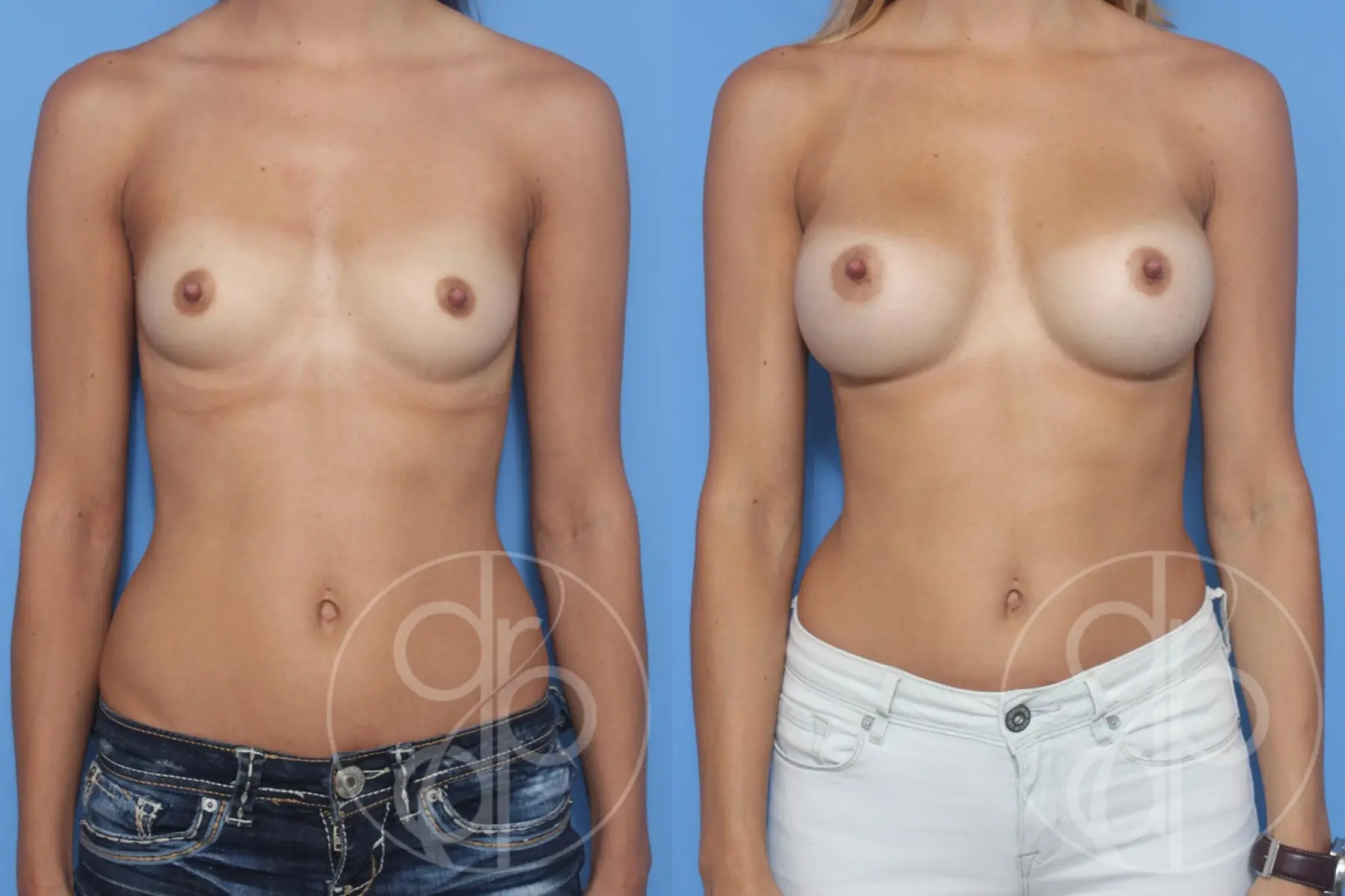 patient 13016 breast augmentation before and after result - Before and After 1