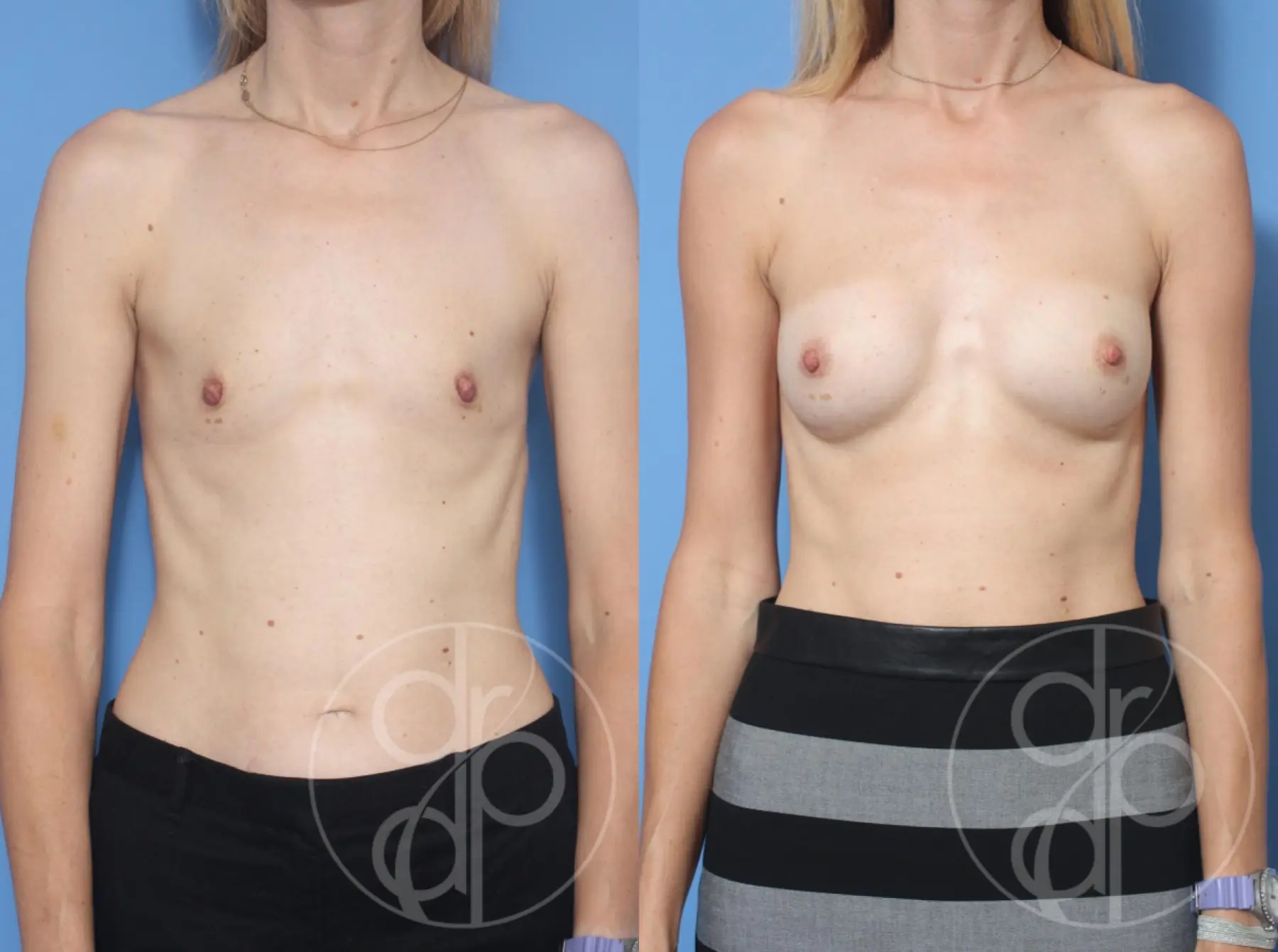 patient 13422 breast augmentation before and after result - Before and After 1