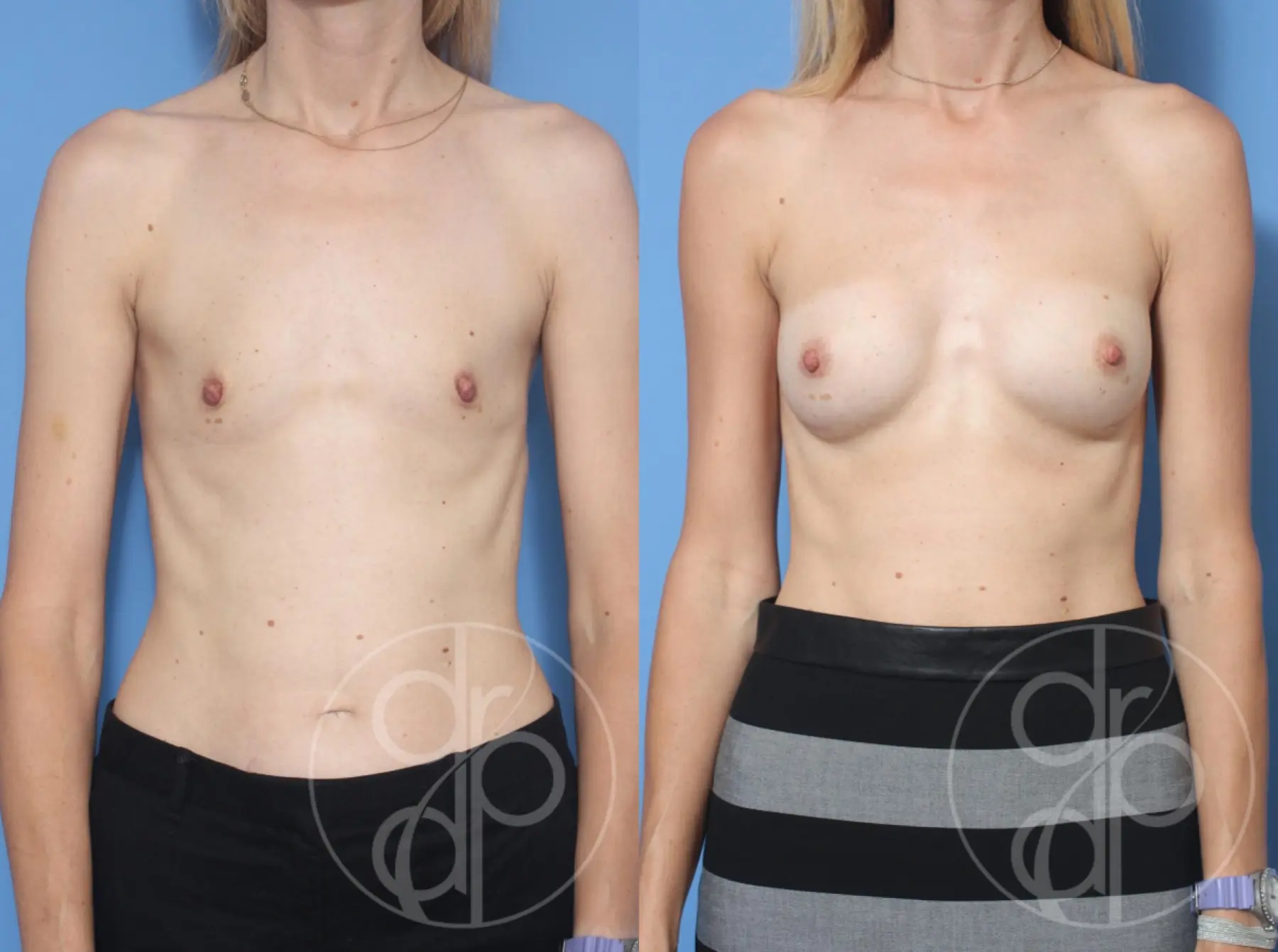 patient 13422 breast augmentation before and after result - Before and After