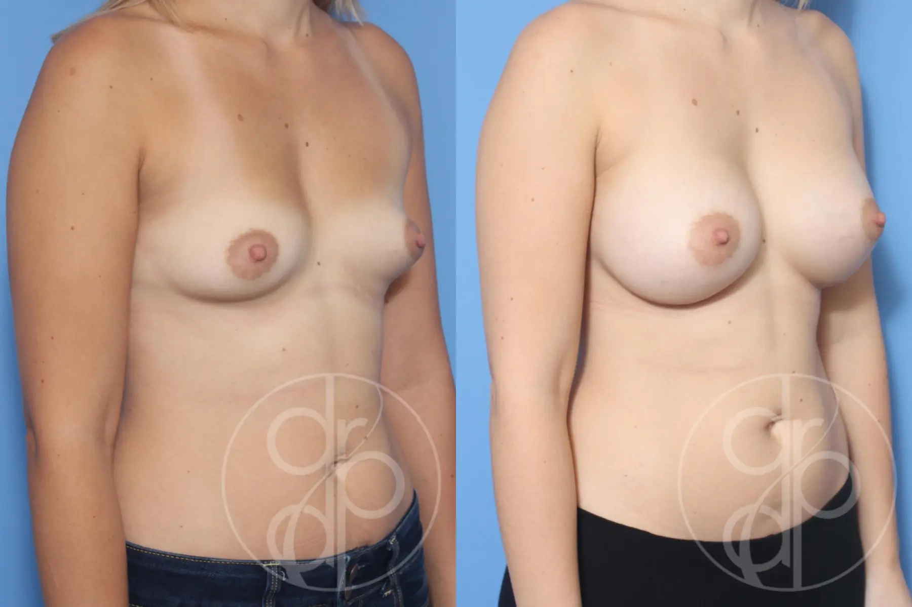 patient 12528 breast augmentation before and after result - Before and After 3