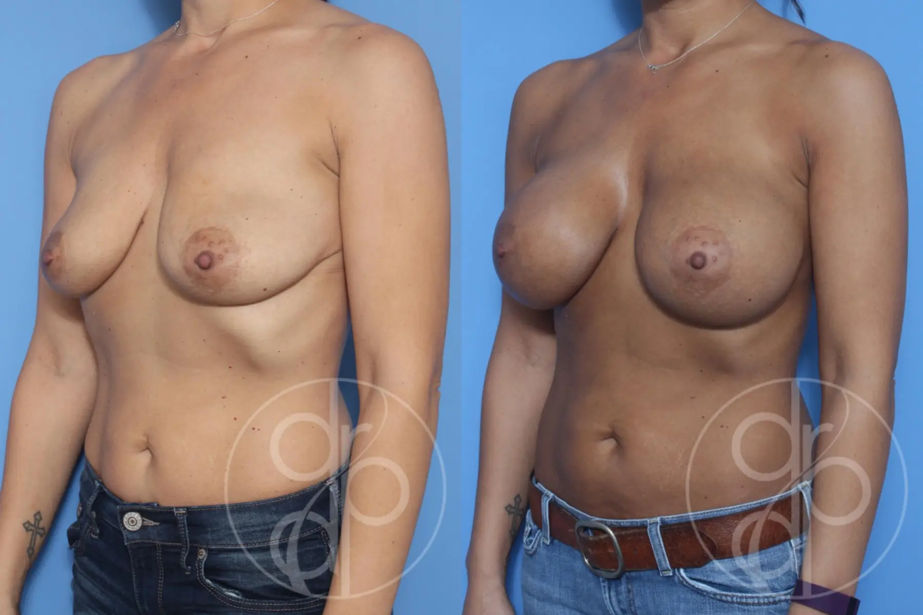 patient 10297 breast augmentation before and after result - Before and After 3