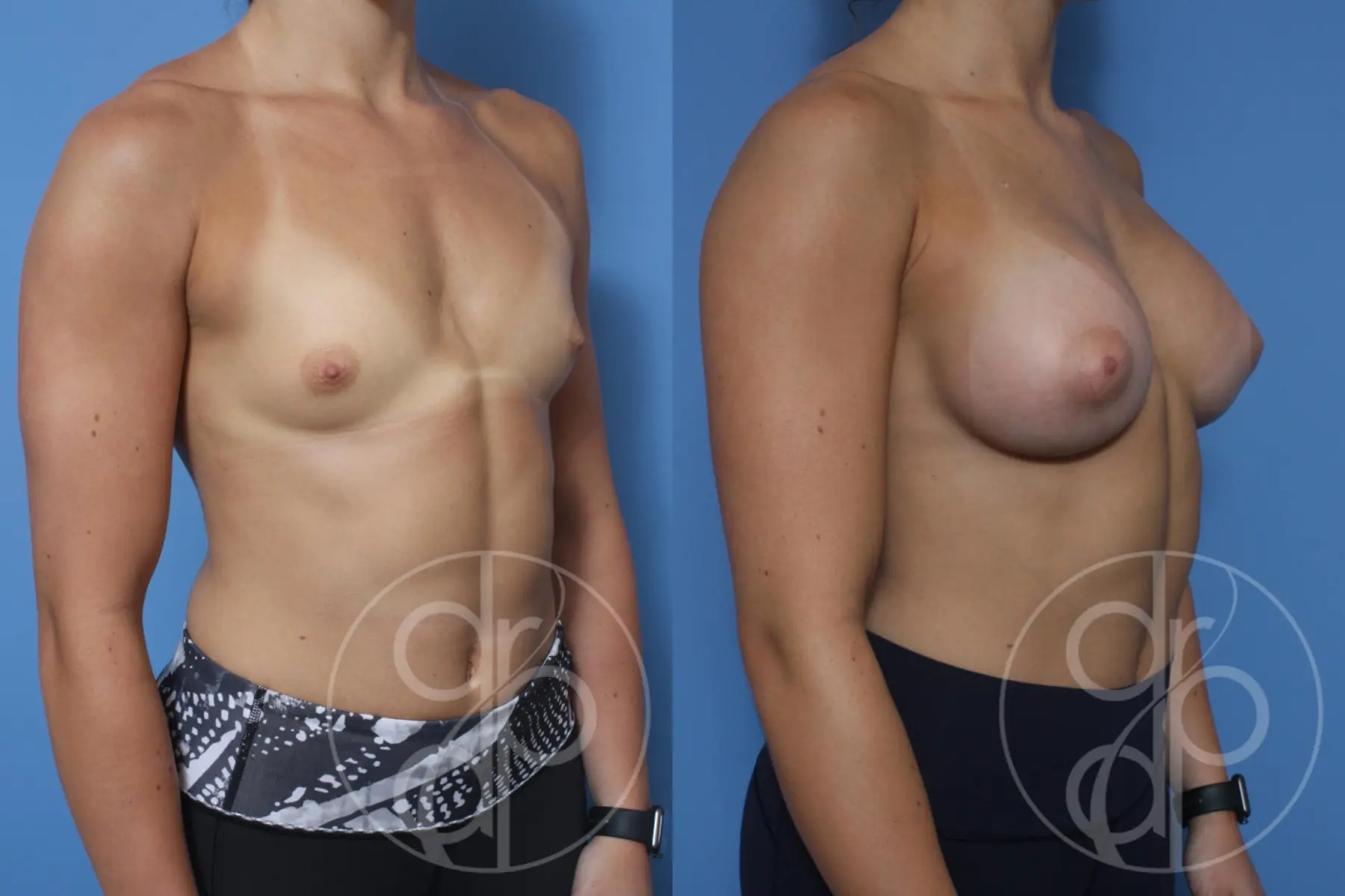 patient 12251 breast augmentation before and after result - Before and After 2