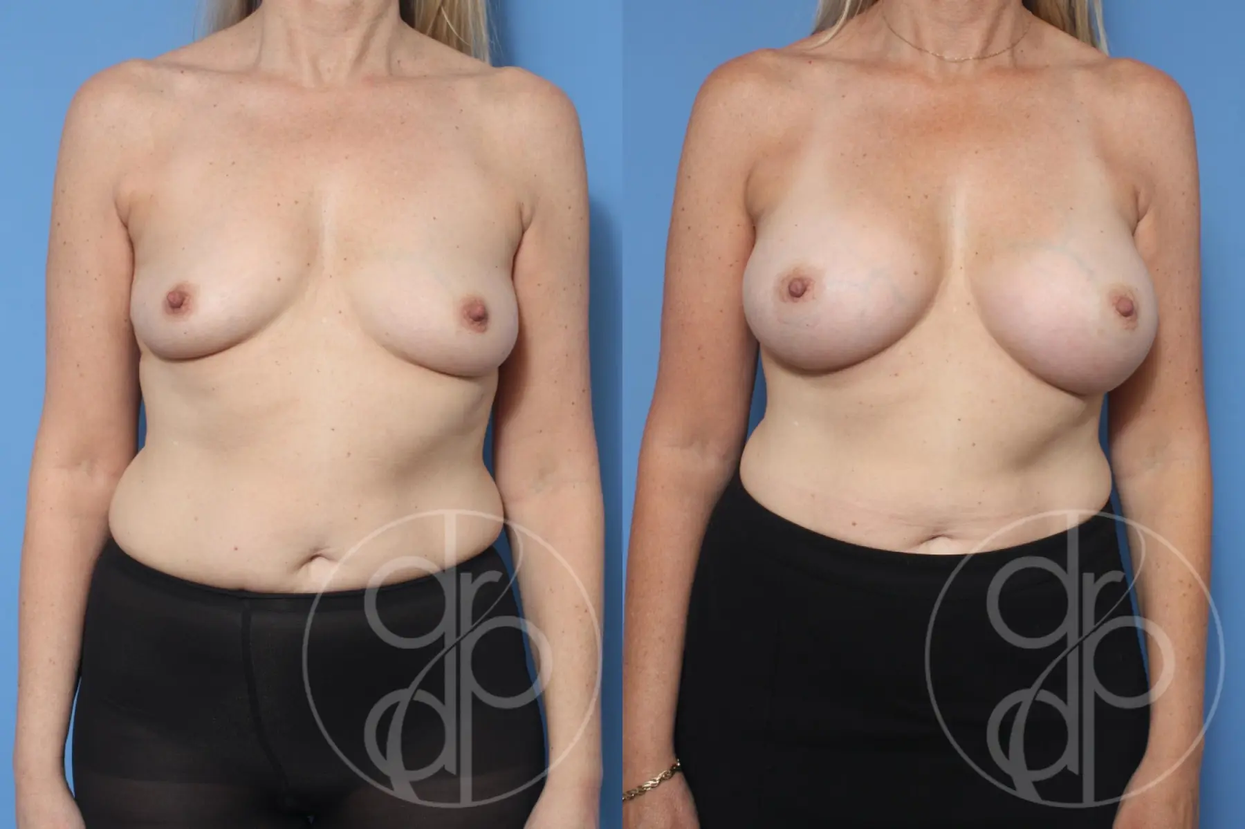 patient 12085 breast augmentation before and after result - Before and After 1