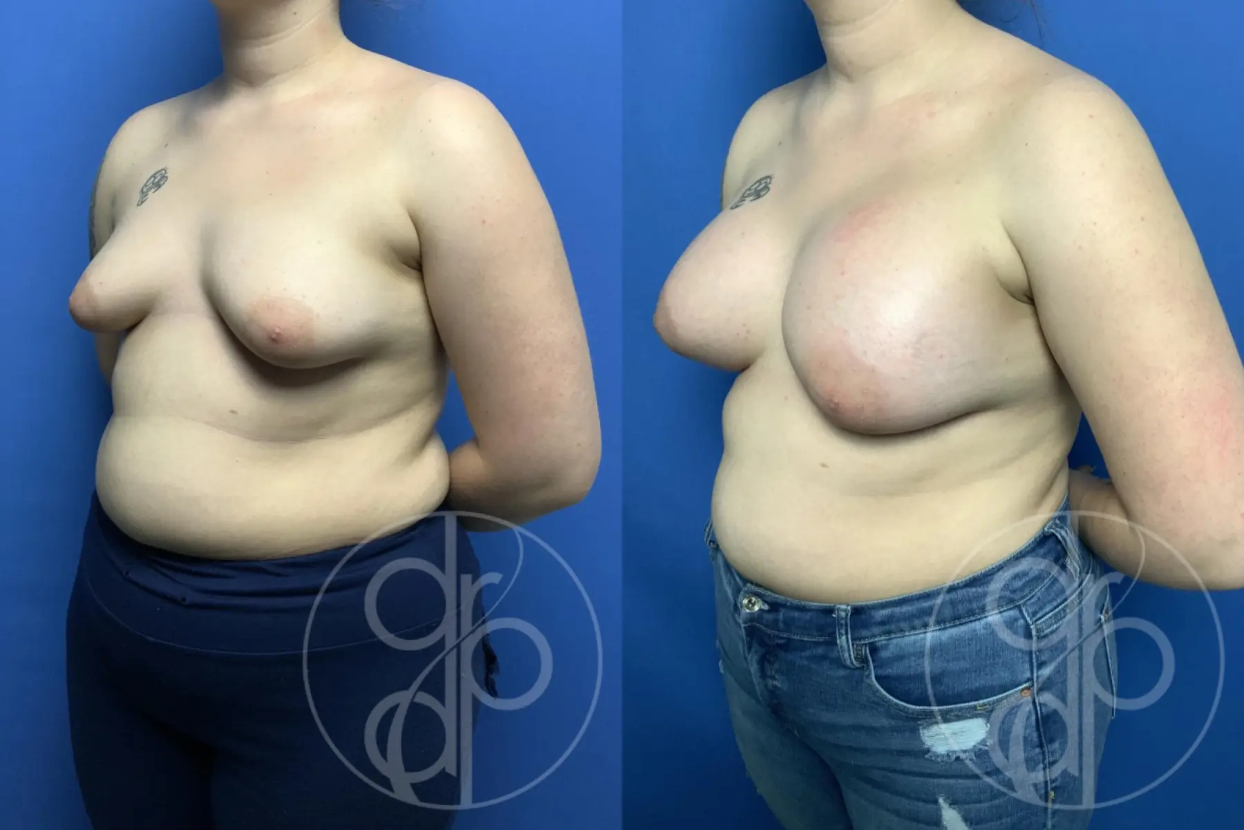 patient 13547 breast augmentation before and after result - Before and After 3
