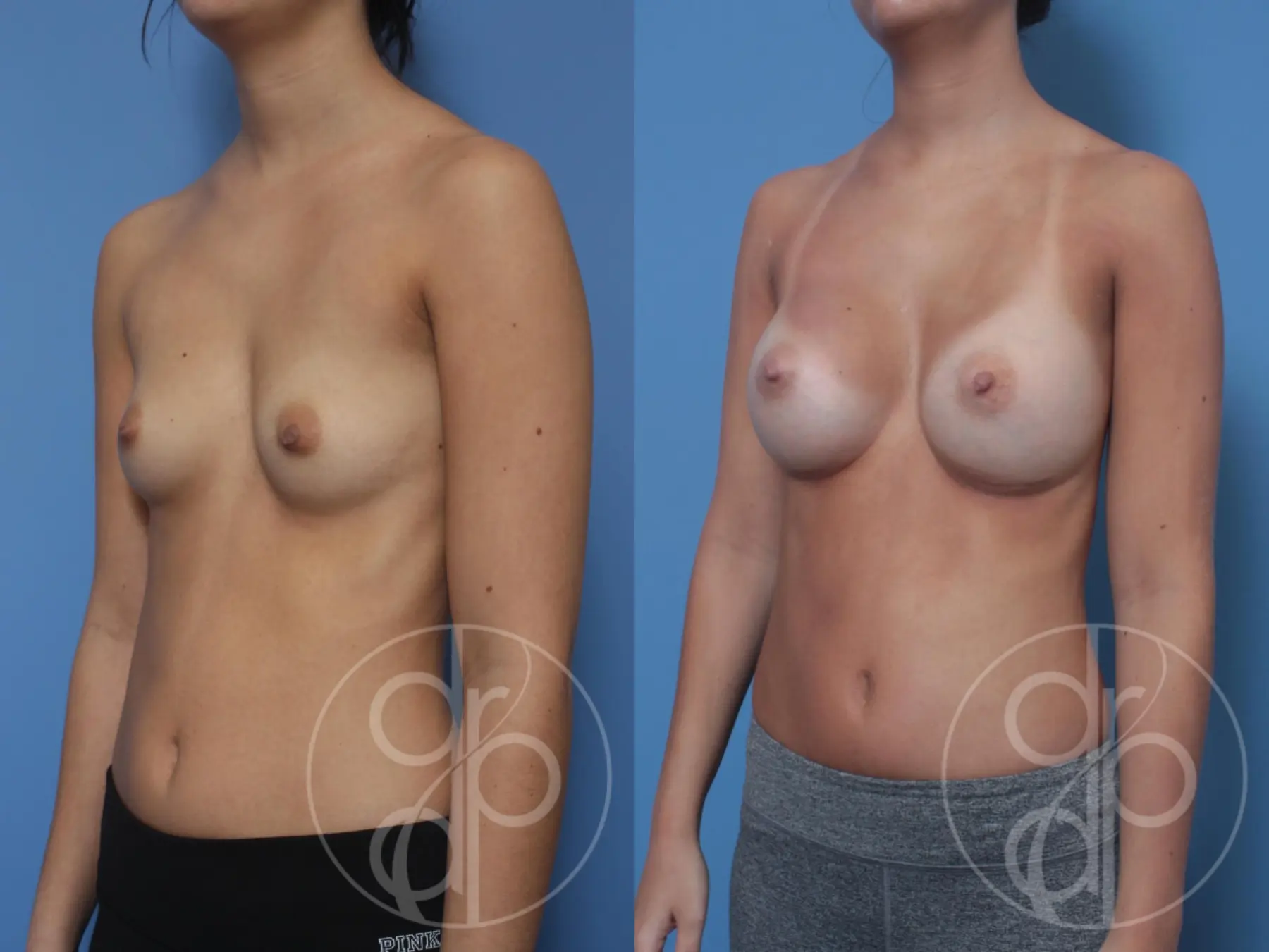 patient 10303 breast augmentation before and after result - Before and After 4
