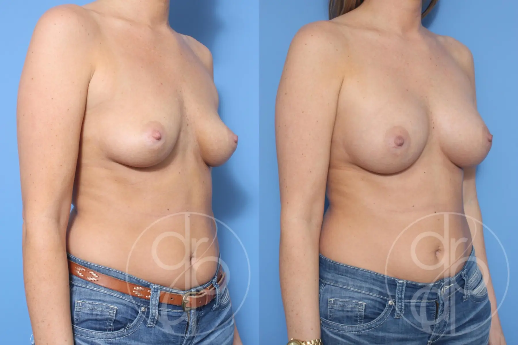 patient 10552 breast augmentation before and after result - Before and After 2