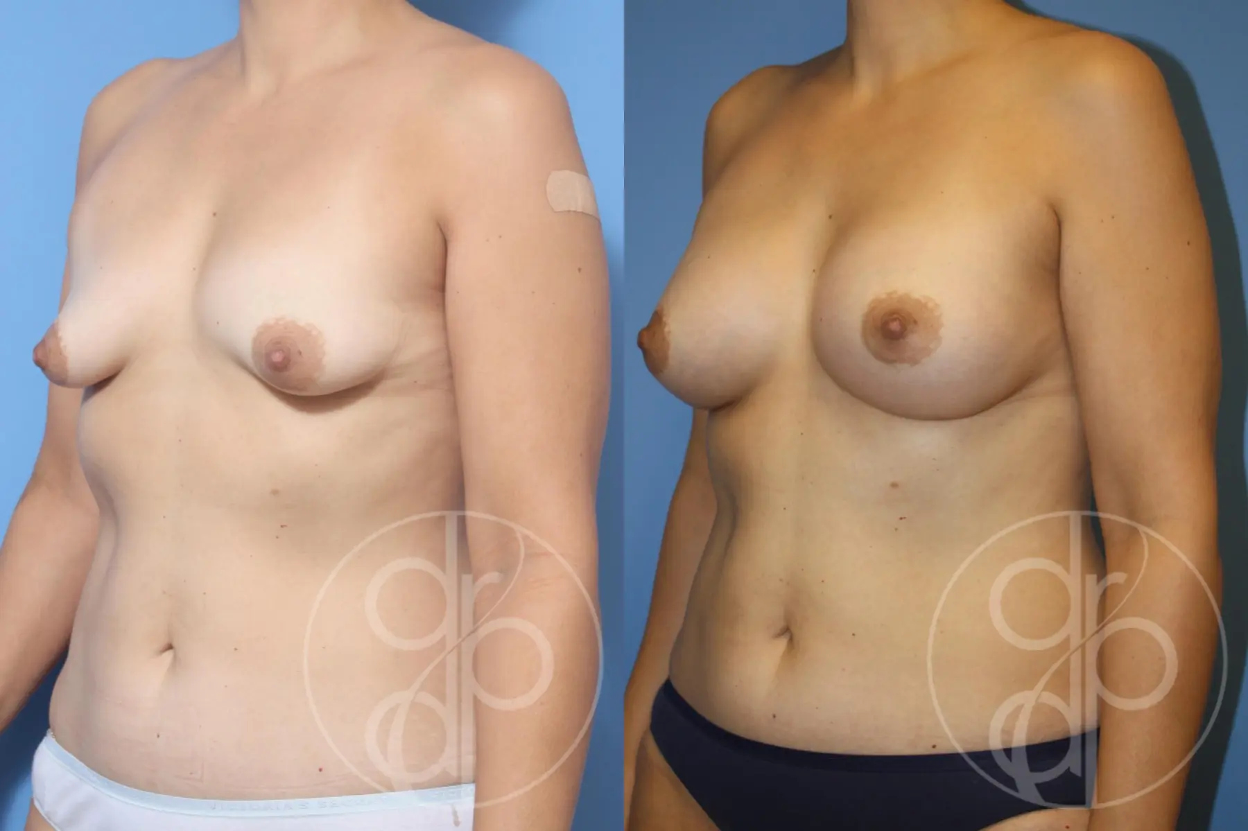 patient 12812 breast augmentation before and after result - Before and After 2