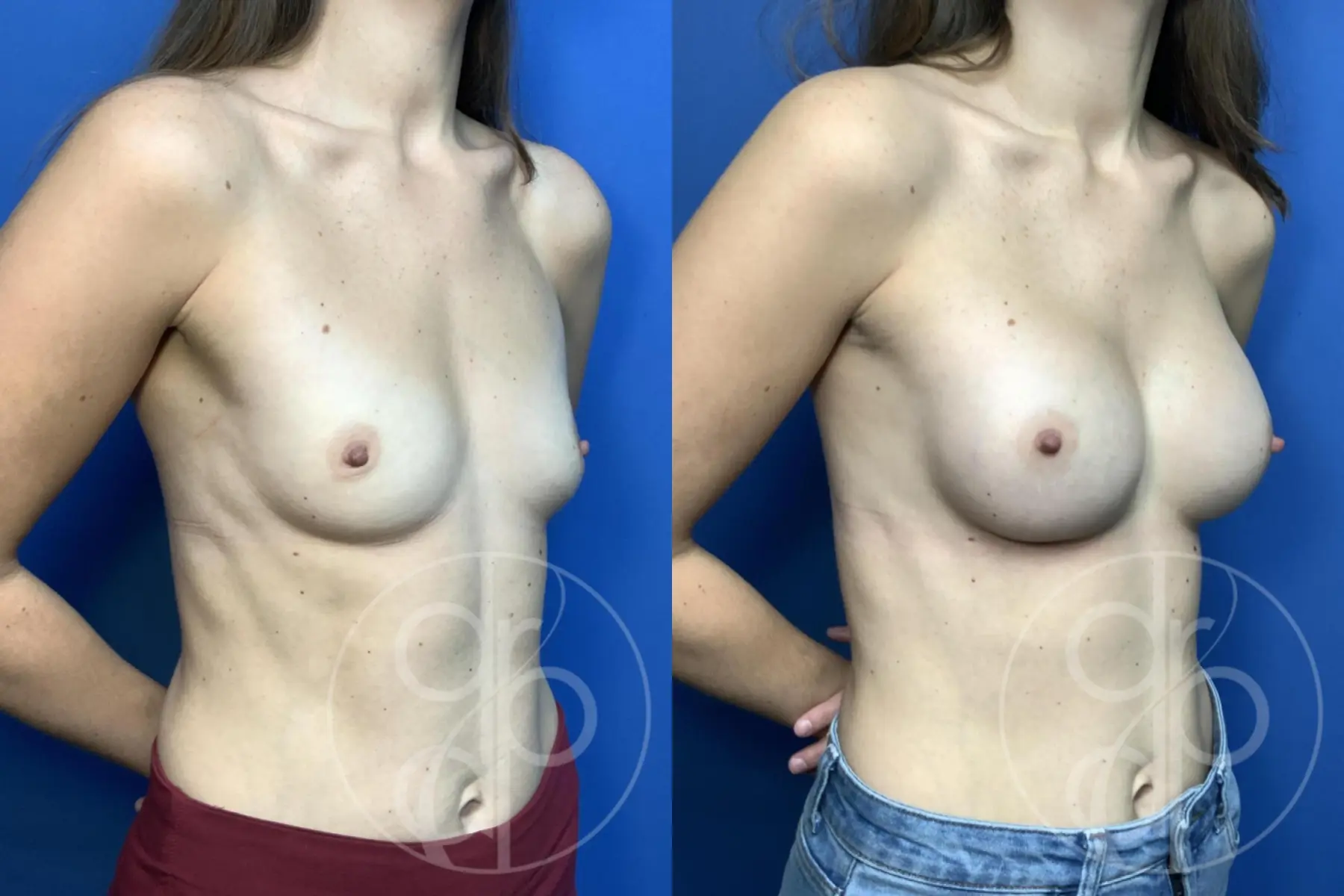 Breast Augmentation: Patient 92 - Before and After 2