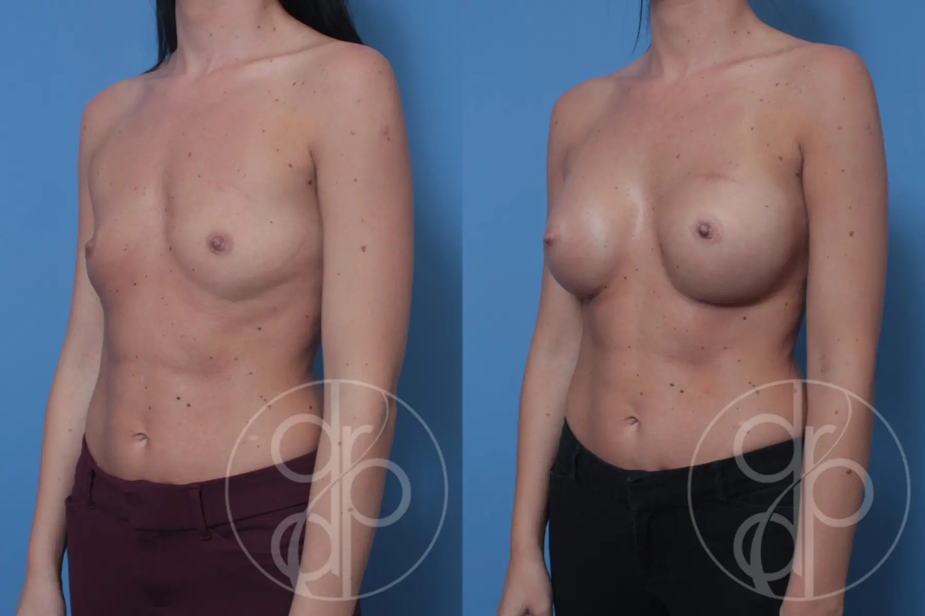 patient 10585 breast augmentation before and after result - Before and After 3