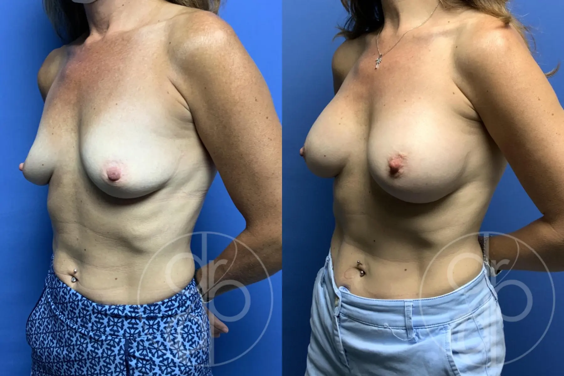 patient 12496 breast augmentation before and after result - Before and After 3