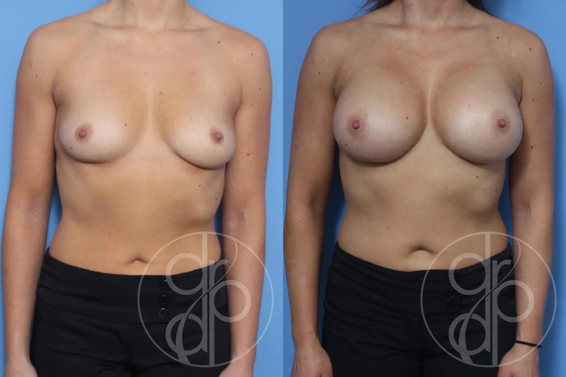 patient 13184 breast augmentation before and after result - Before and After 1