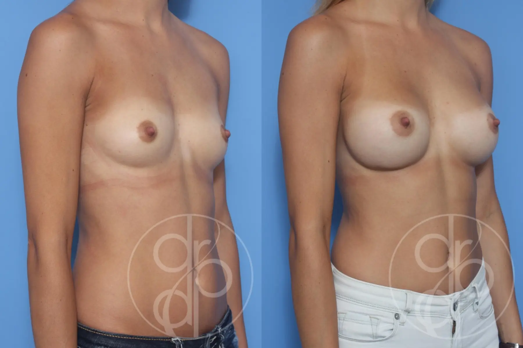 patient 13016 breast augmentation before and after result - Before and After 2