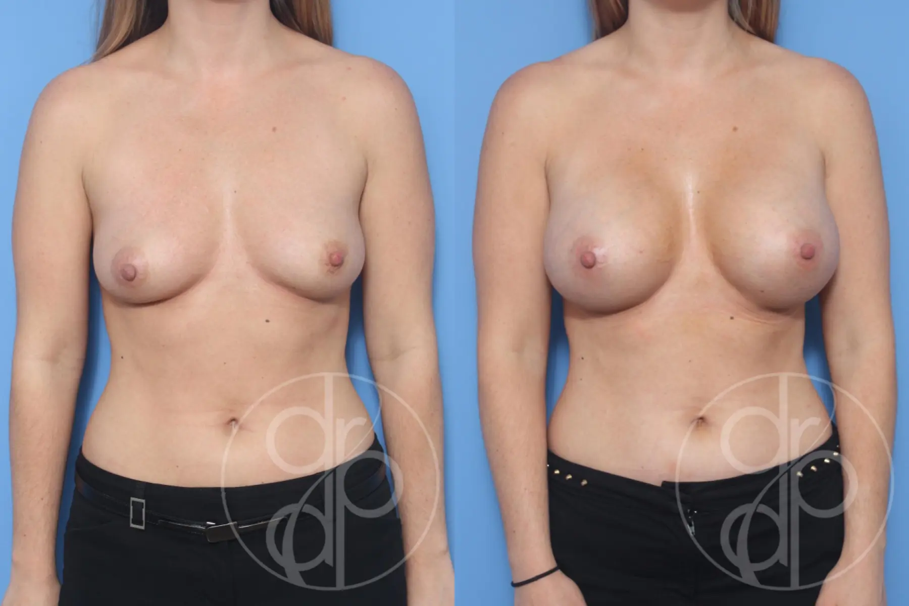 patient 13165 breast augmentation before and after result - Before and After 1