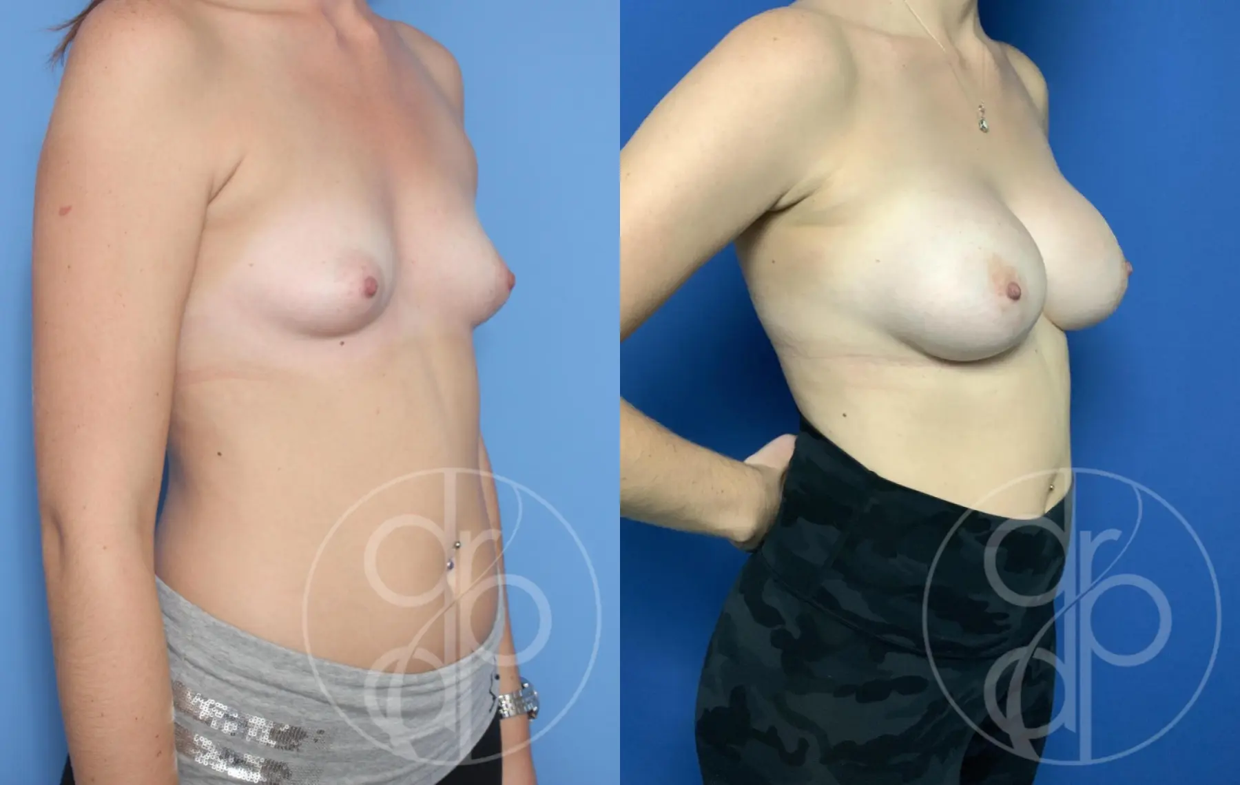 patient 10544 breast augmentation before and after result - Before and After 2