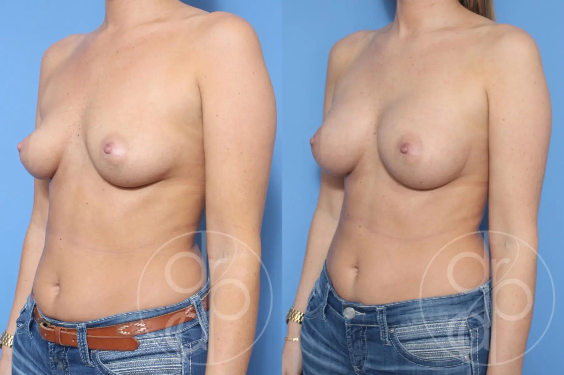 patient 10552 breast augmentation before and after result - Before and After 3