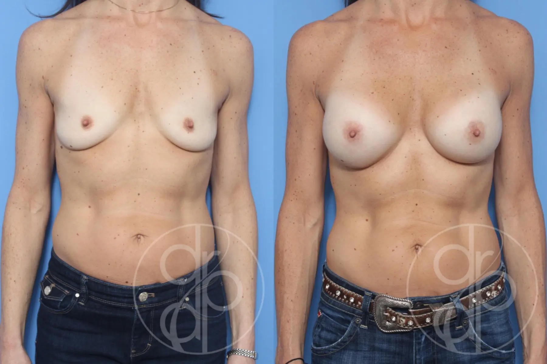patient 10383 breast augmentation before and after result - Before and After 1