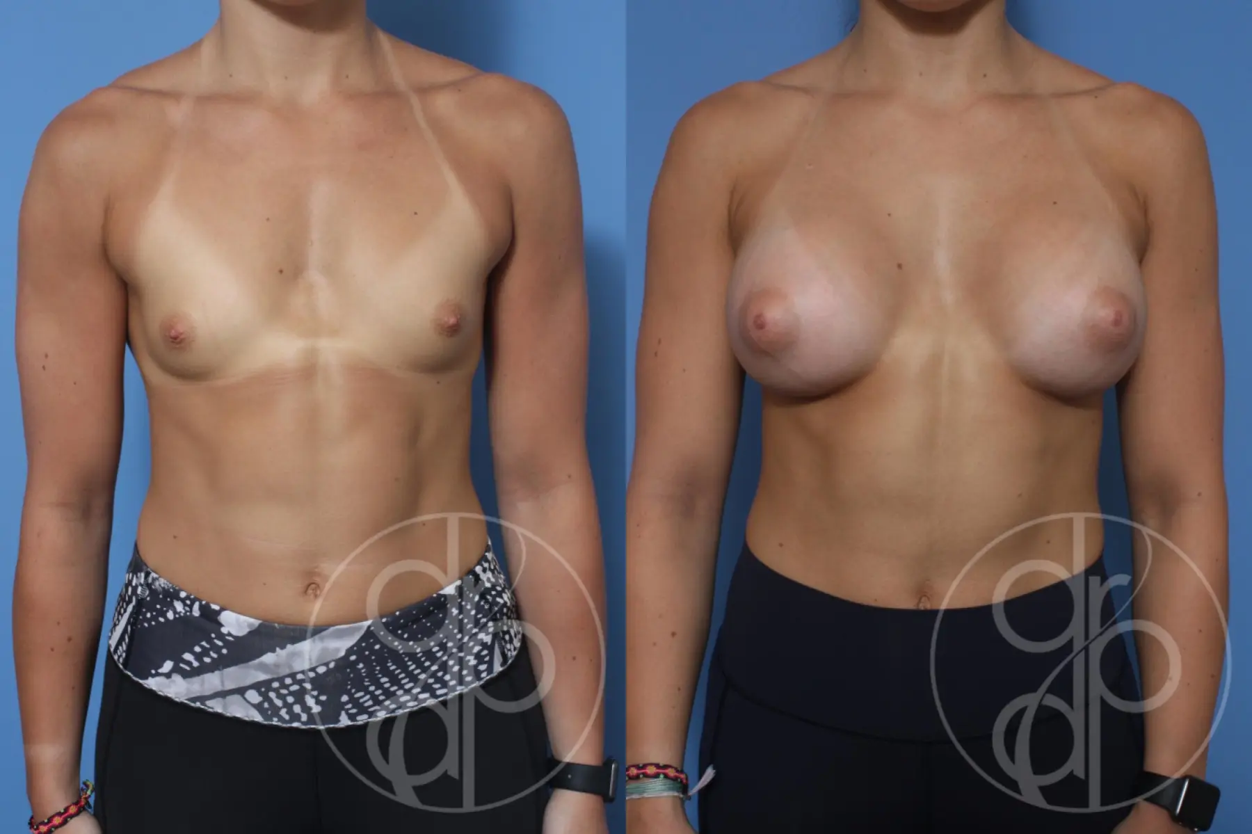 patient 12251 breast augmentation before and after result - Before and After 1