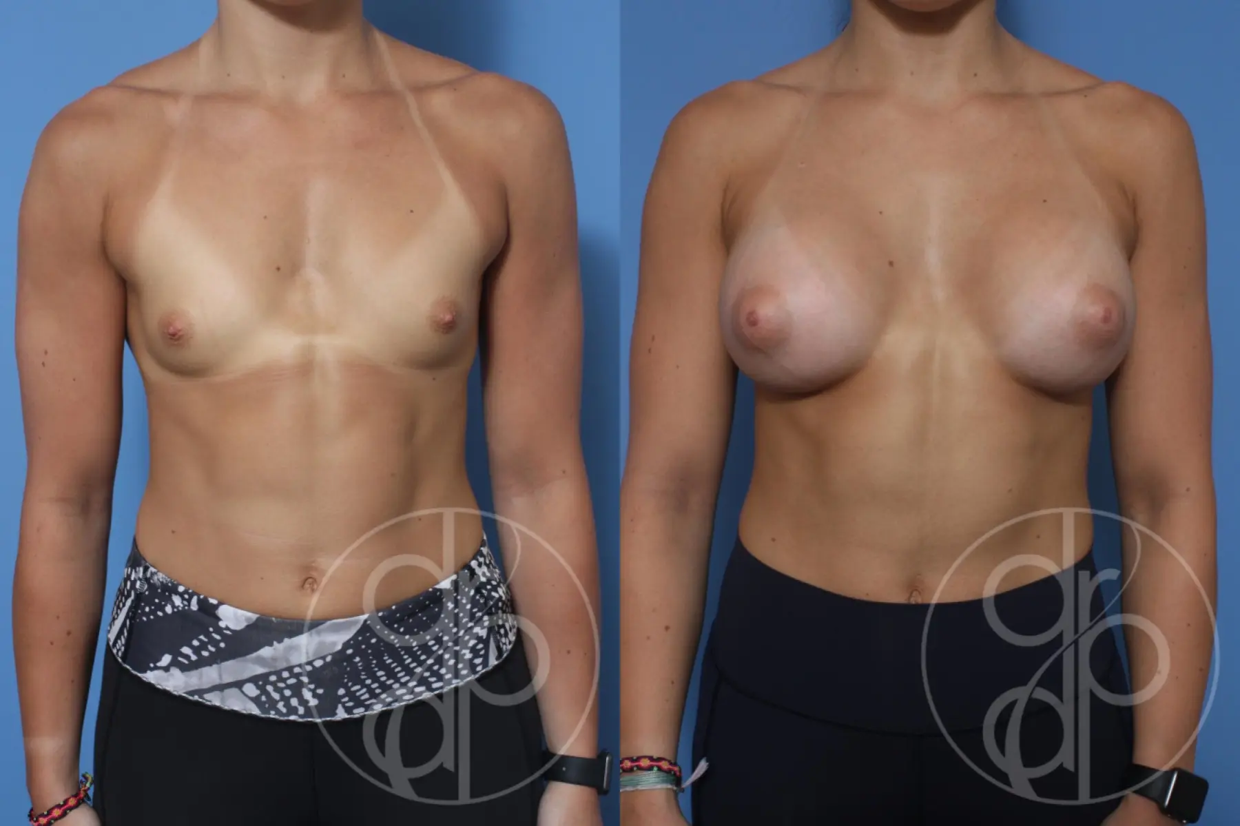 patient 12251 breast augmentation before and after result - Before and After