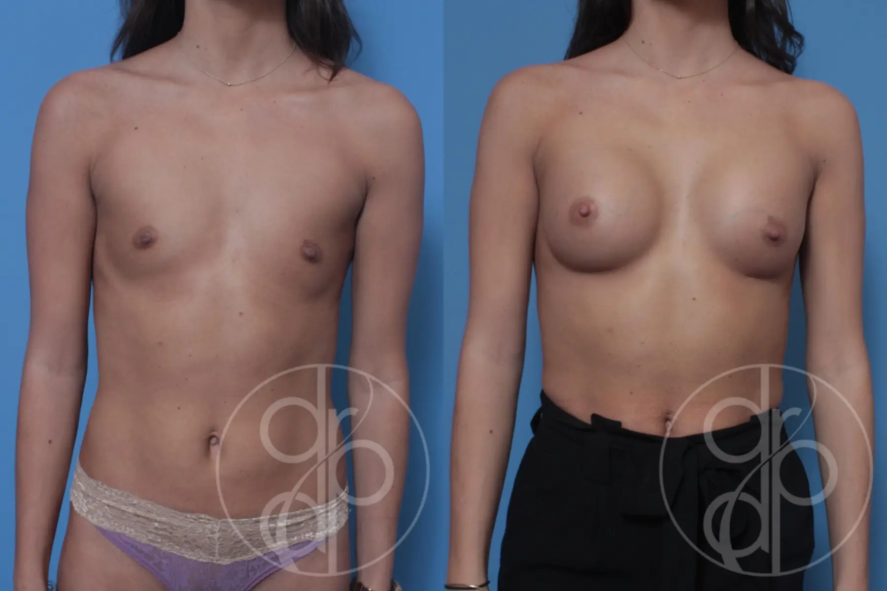 patient 10357 breast augmentation before and after result - Before and After 1