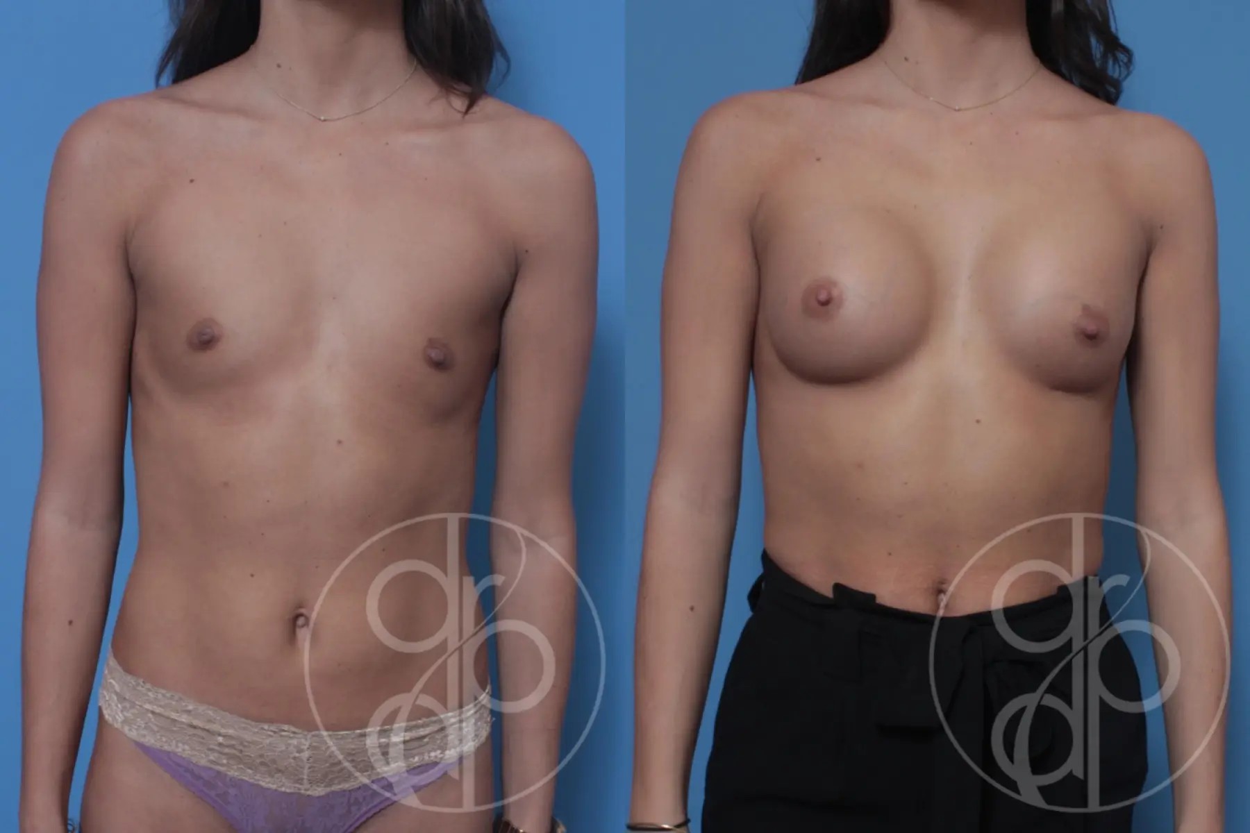 patient 10357 breast augmentation before and after result - Before and After
