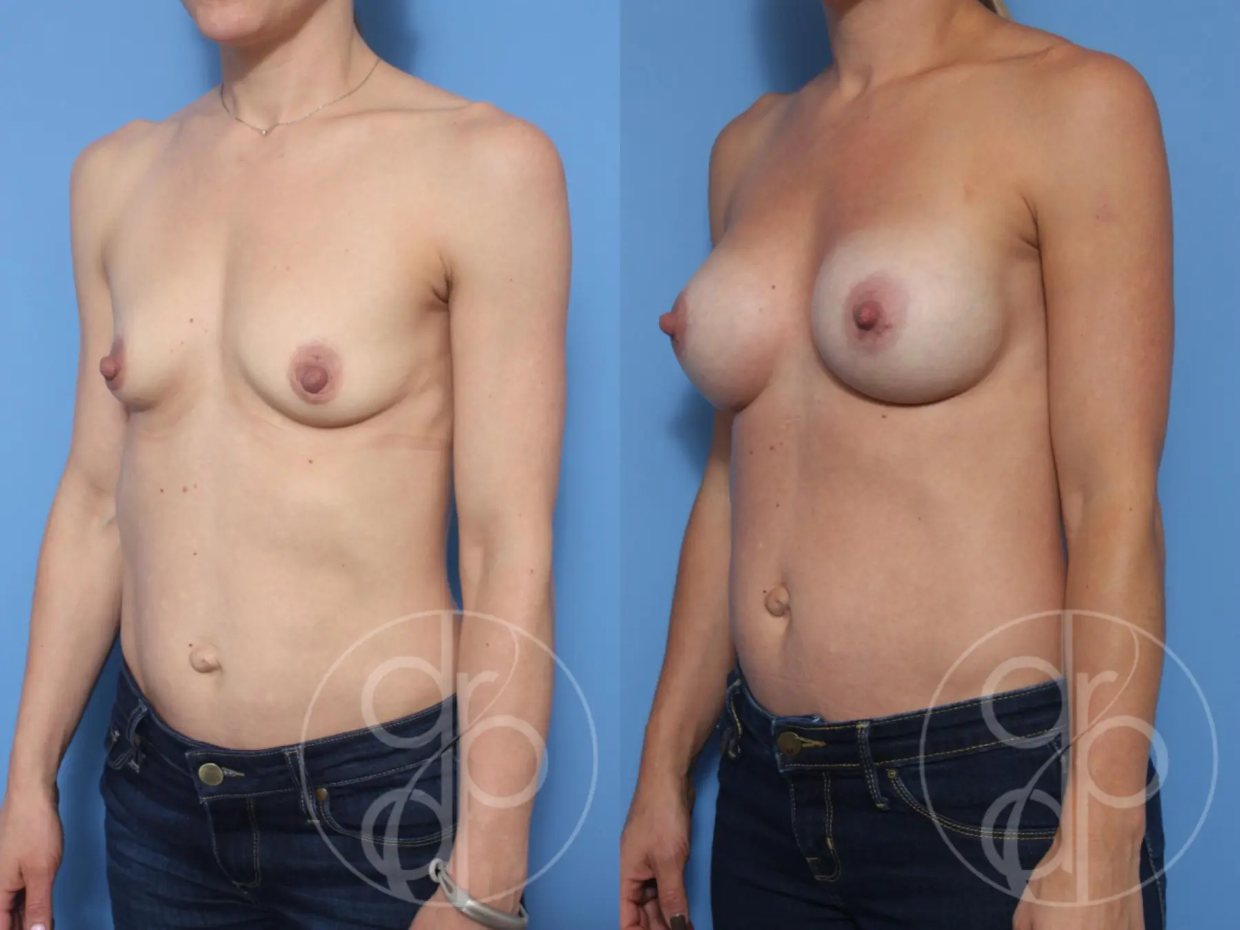 patient 13216 breast augmentation before and after result - Before and After 3