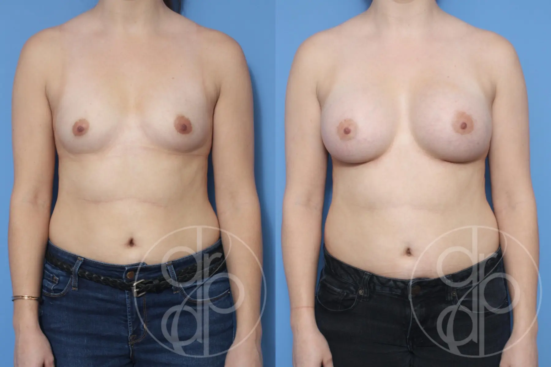 patient 13306 breast augmentation before and after result - Before and After 1