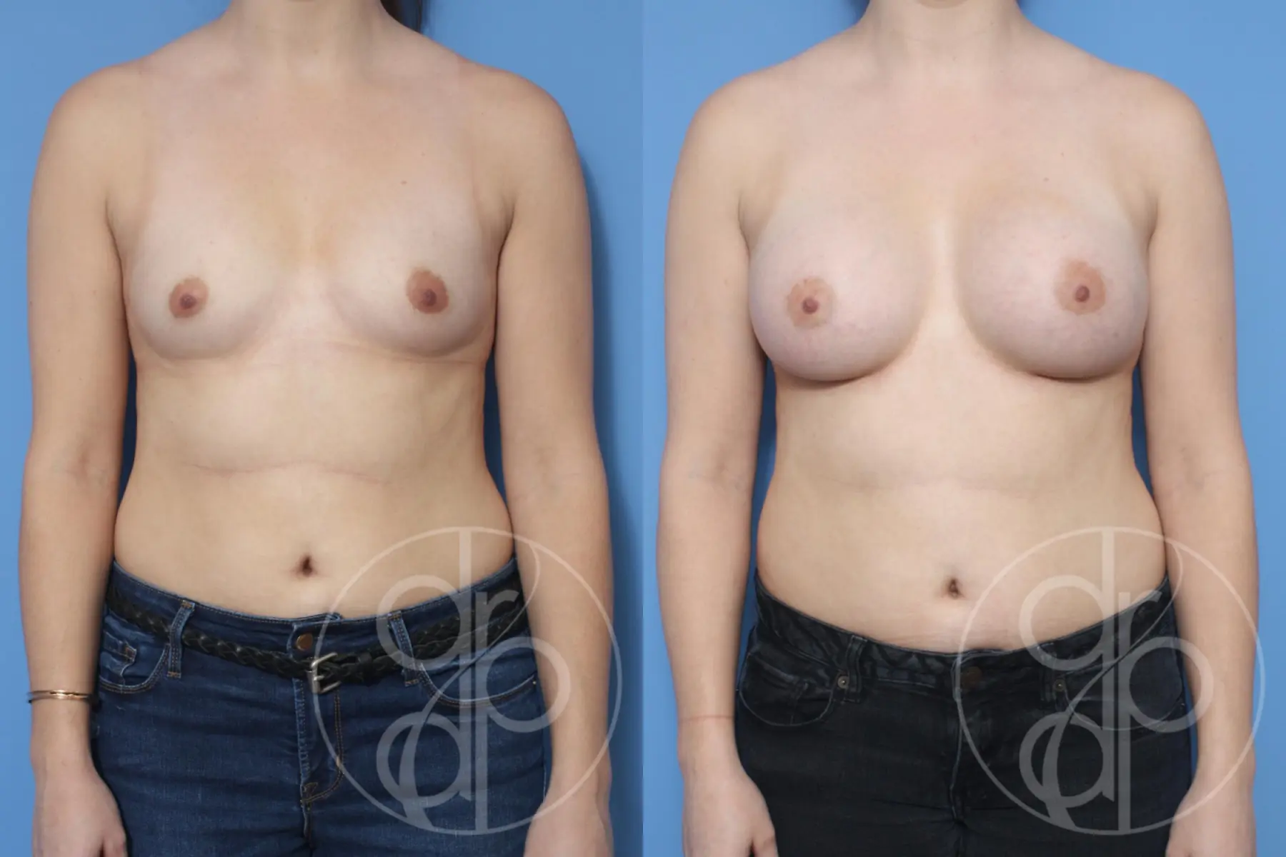 patient 13306 breast augmentation before and after result - Before and After