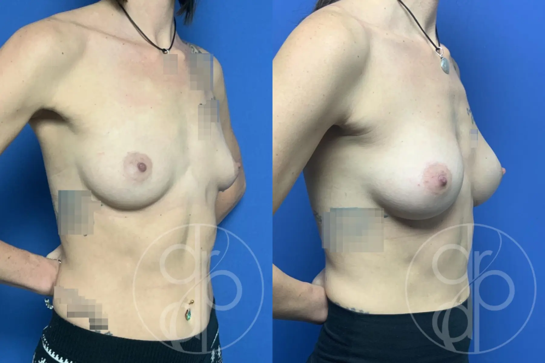 patient 12760 breast augmentation before and after result - Before and After 2