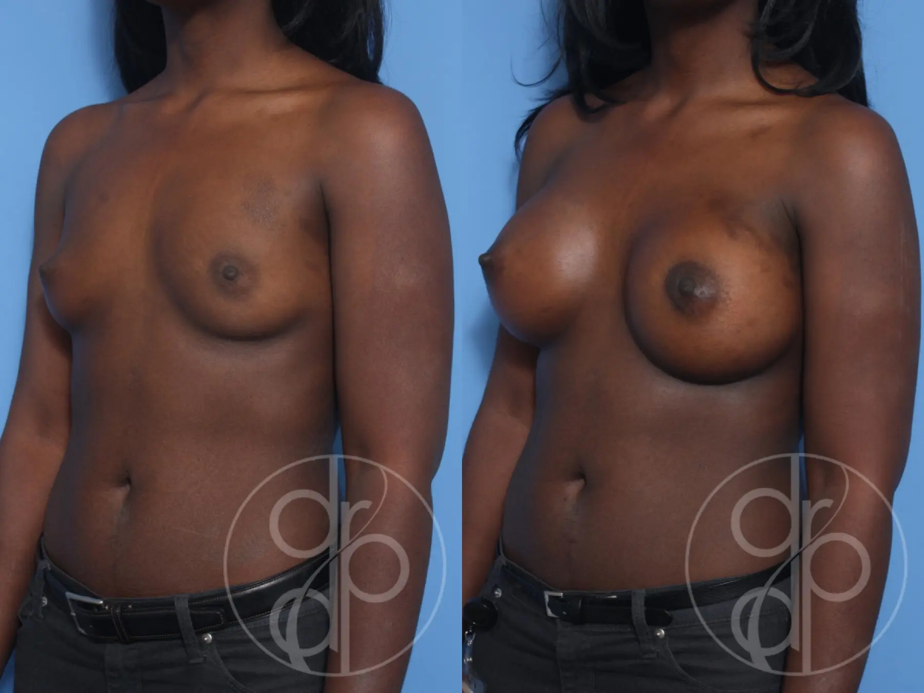 patient 12947 breast augmentation before and after result - Before and After 3