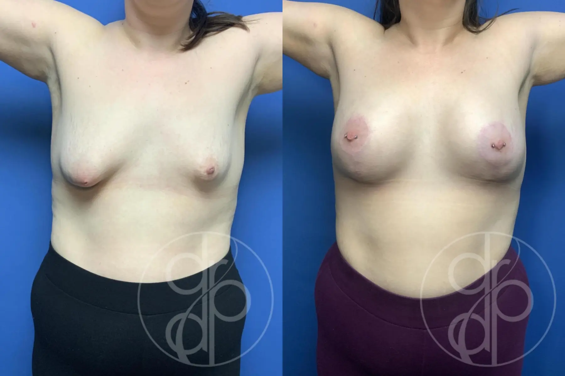 Breast Augmentation: Patient 89 - Before and After 2