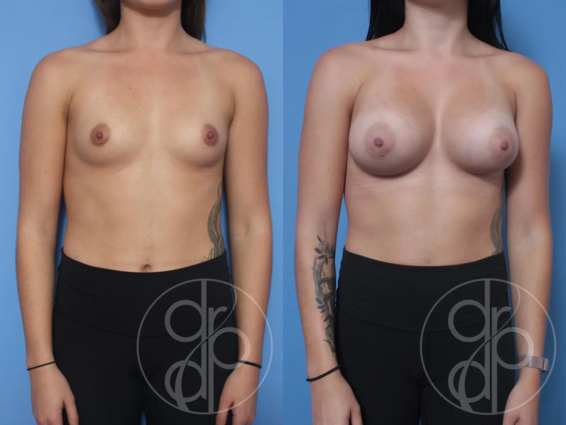 patient 10289 breast augmentation before and after result - Before and After 1