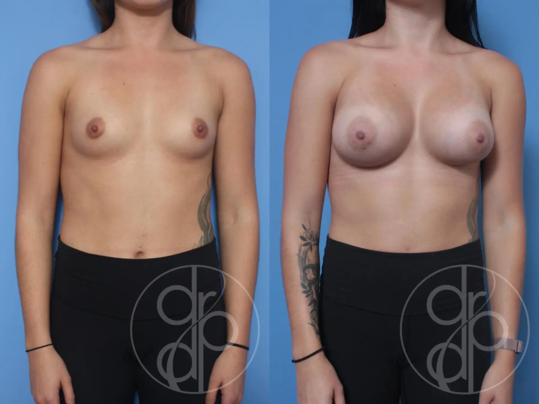 patient 10289 breast augmentation before and after result - Before and After