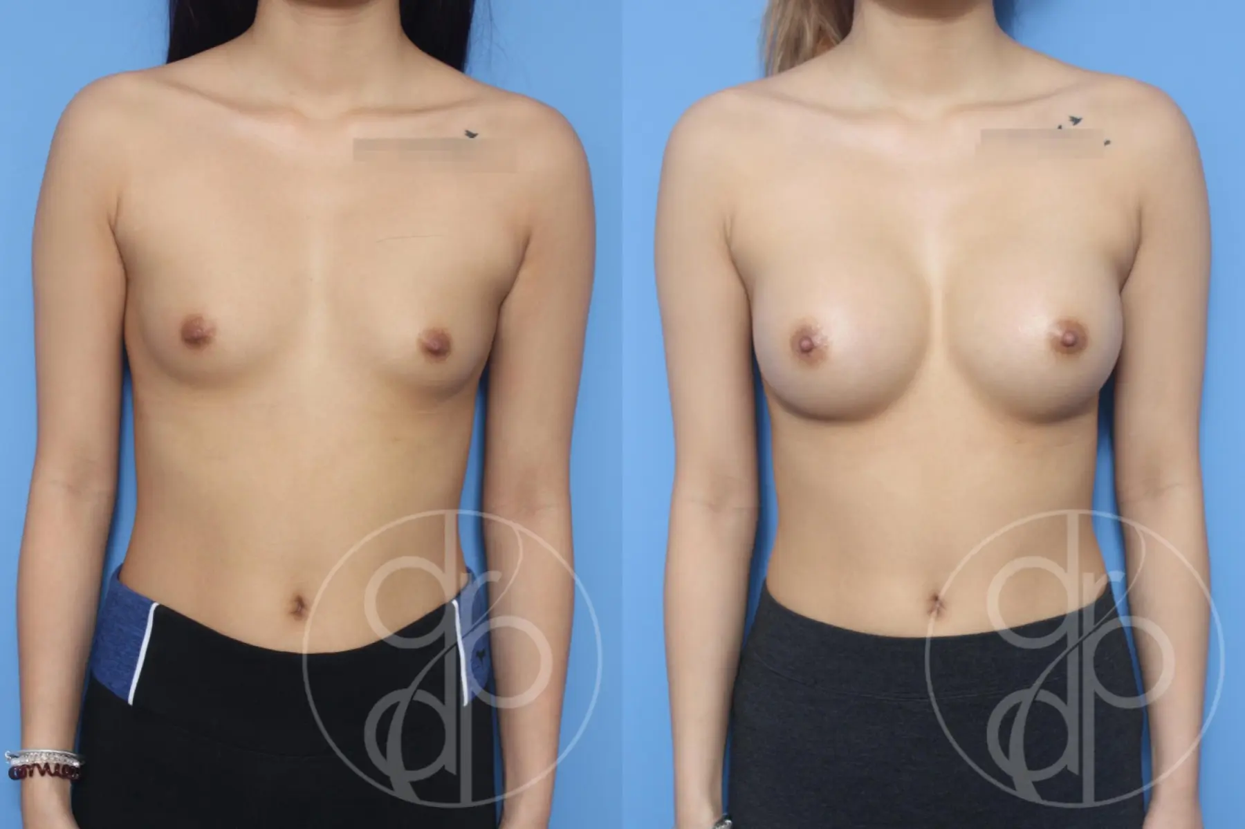 patient 11868 breast augmentation before and after result - Before and After 1