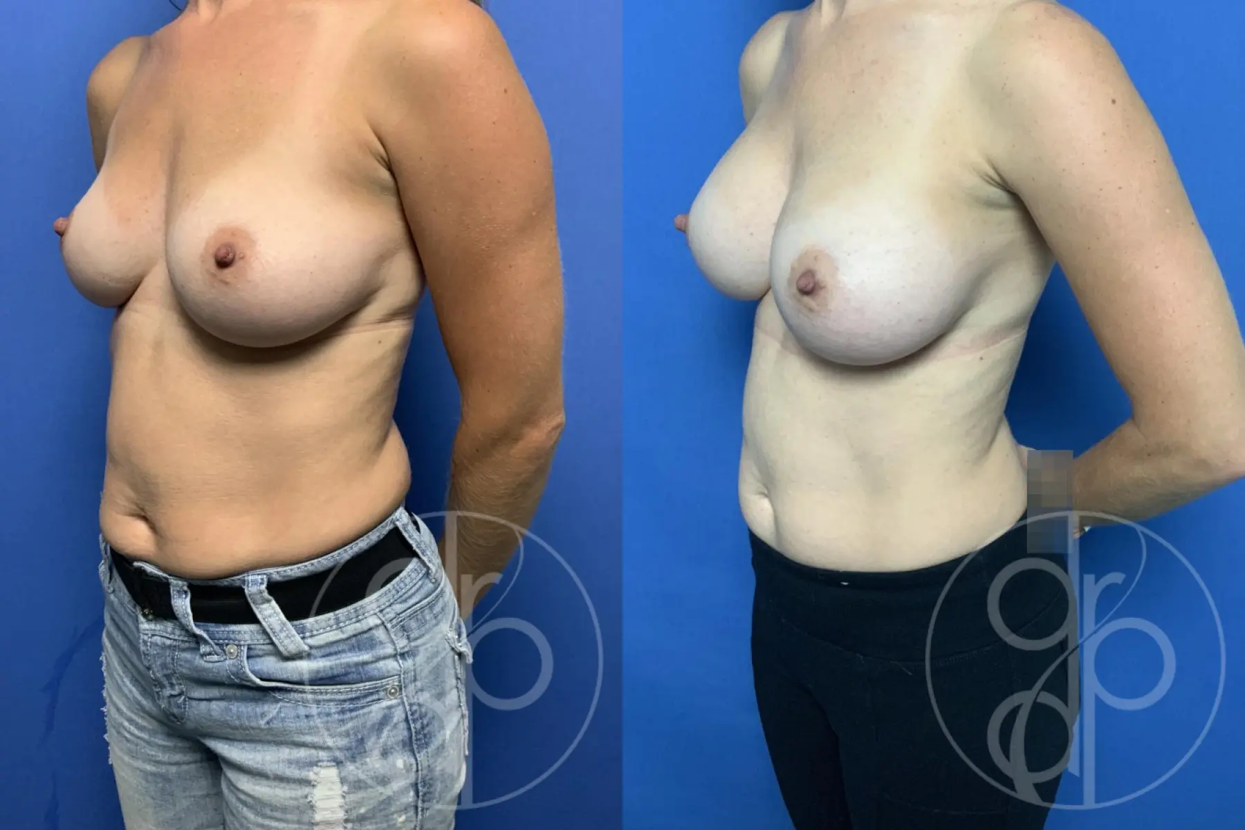 patient 12507 breast augmentation before and after result - Before and After 3