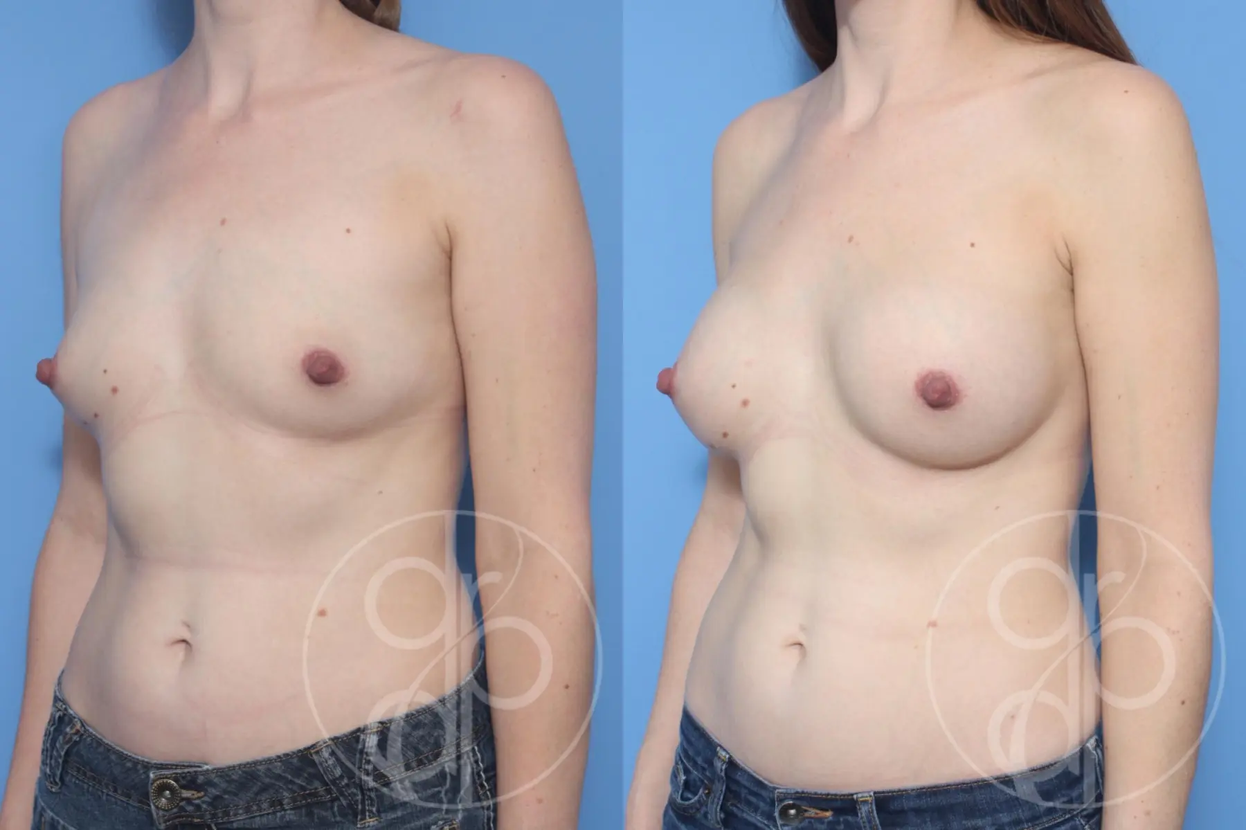 patient 10407 breast augmentation before and after result - Before and After 3