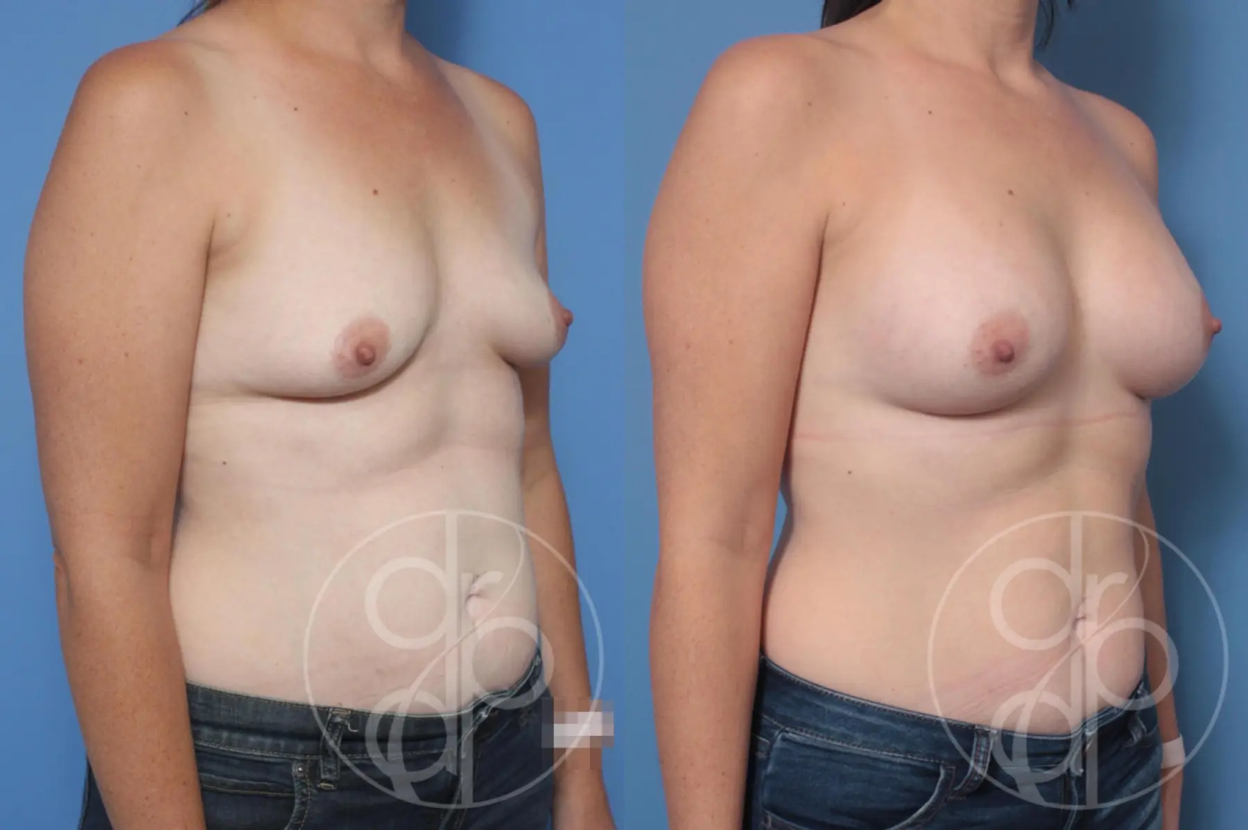 Breast Augmentation: Patient 91 - Before and After 3