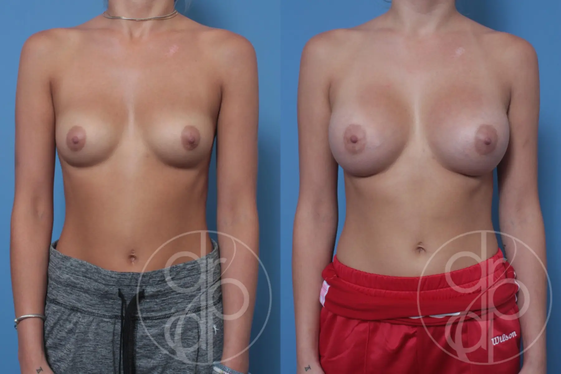 patient 10573 breast augmentation before and after result - Before and After 1