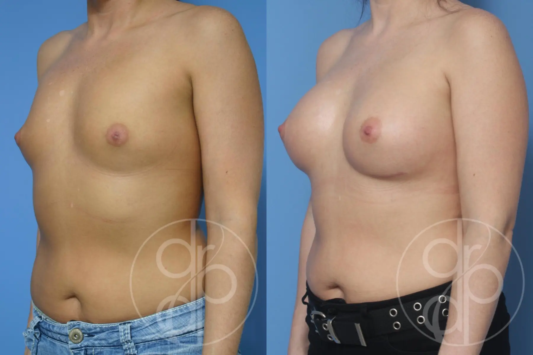 patient 13054 breast augmentation before and after result - Before and After 3