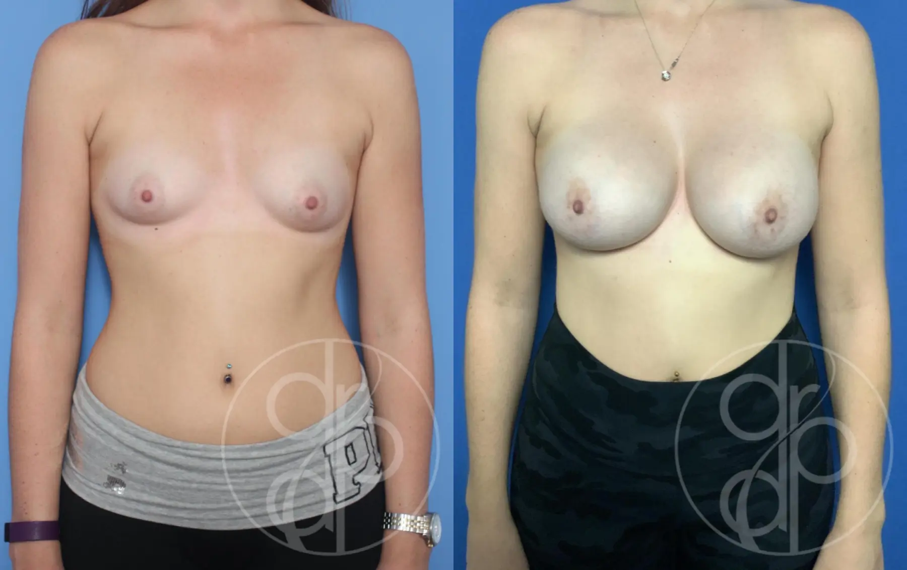 patient 10544 breast augmentation before and after result - Before and After 1